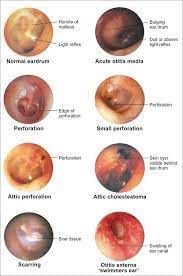Pneumatic otoscopy | Ear health, Otitis media, Otitis